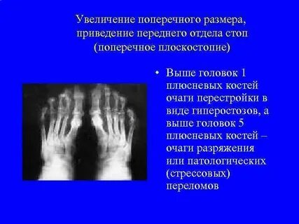 Перелом плюсневой кости код по мкб