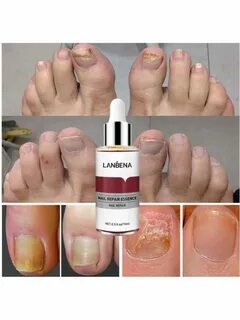 Lanbena от грибка ногтей
