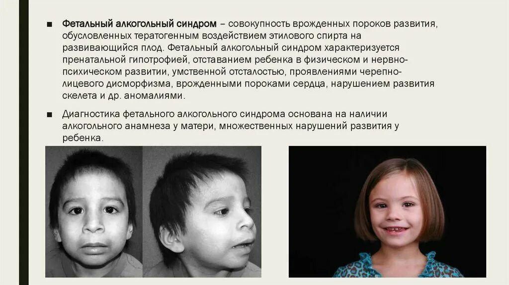 Синдром алкогольного ребенка. Алкогольный синдром плода (фас). фитально алкогольный синдром. синдром алкоголь фетальный алкогольный. фас алкогольный синдром у детей.