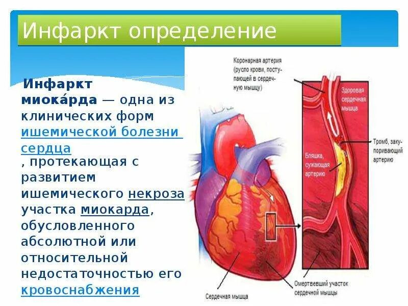 Презентация на тему инфаркт. Инфаркт миокарда определение.