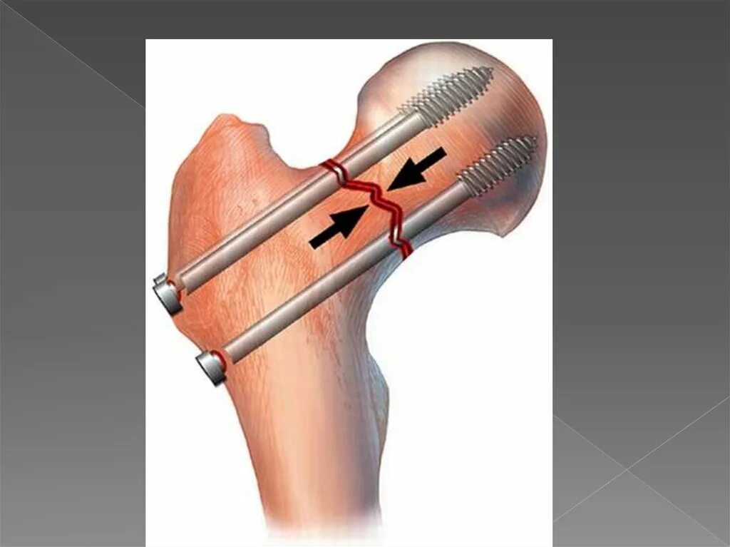 Остеосинтез перелома бедренной кости. Остеосинтез перелома шейки бедра канюлированными винтами. Перелом шейки бедра остеосинтез. Остеосинтез шейки бедренной кости винтами.