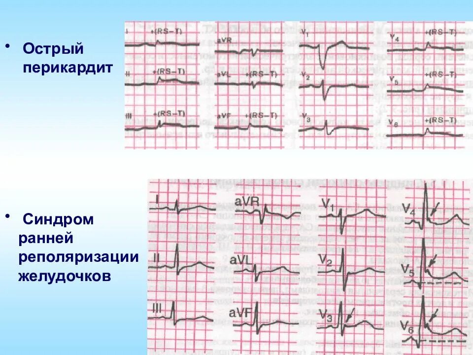 Преждевременная деполяризация желудочков. Ранняя реполяризация желудочков на экг. ранняя реполяризация желудочков сердца на экг. экг при синдроме ранней реполяризации. синдром ранней реполяризации желудочков на экг.