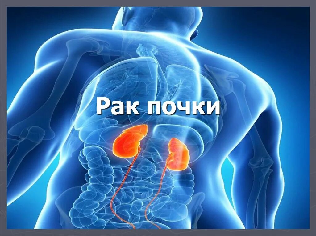 Почечная рас это. Рак почки причины