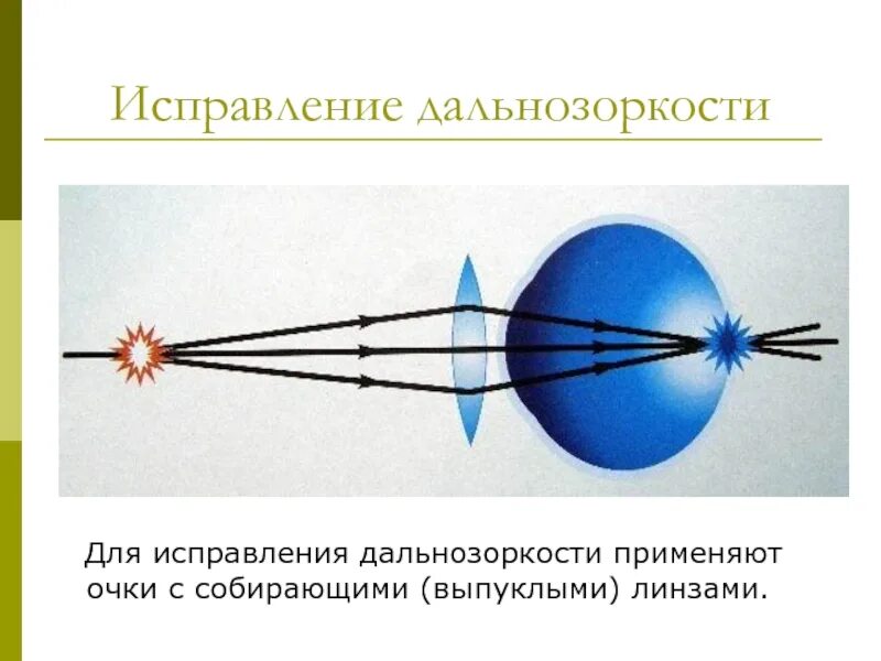 Дальнозорким необходимо использовать очки. Линзы для коррекции дальнозоркости физика. для устранения дальнозоркости применяют очки с собирающими линзами. для коррекции гиперметропии применяются линзы. гиперметропия коррекция линзами.