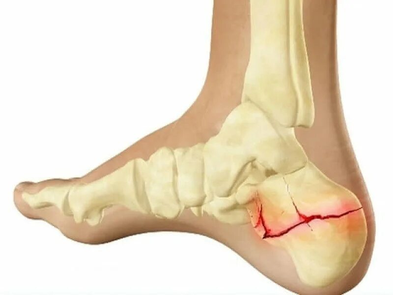 Трещина кости лечение. Перелом пяточной кости стопы. Клювовидный перелом пяточной кости. Перелом пяточной кости симптомы. Перелом остеофита пяточной кости.