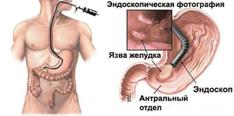 Удаление воздуха из желудка. Двенадцатиперстная кишка ФГДС. Язвенная болезнь ДПК ФГДС. ФГДС при язвенной болезни желудка. Эндоскопическое исследование язва желудка.