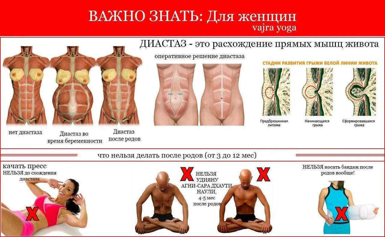 Сводит мышцы пресса. Диастаз прямых мышц живота. расхождение мышц живота. диастаз прямой мышцы живота. расхождение прямых мышц живота.
