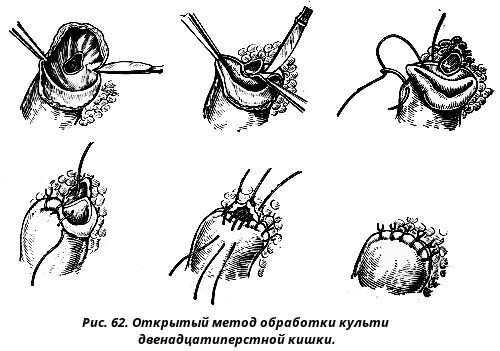 Хирургическое лечение язвы. Обработка культи 12 перстной кишки. Культи двенадцатиперстной кишки методы. Ушивание культи двенадцатиперстной кишки. Закрытие культи двенадцатиперстной кишки.