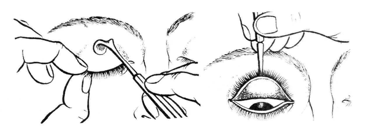 Выворот века верхнего века. Осмотр конъюнктивы, выворачивание век. Выворот верхнего века алгоритм. Как вывернуть веко