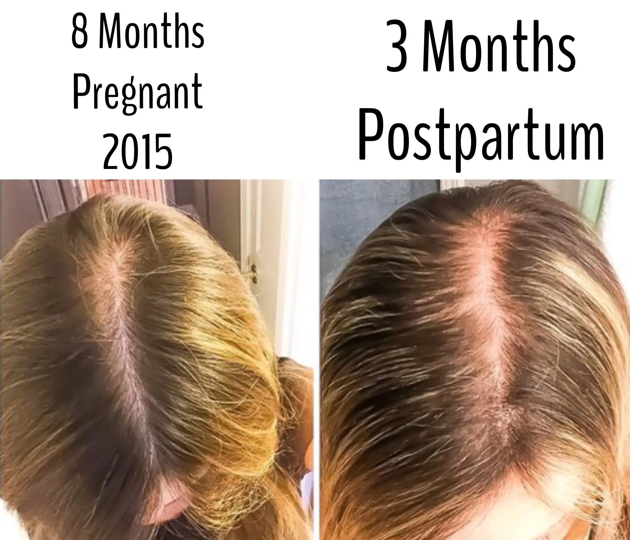 Послеродовое выпадение волос. Волосы после беременности. Postpartum hair loss.