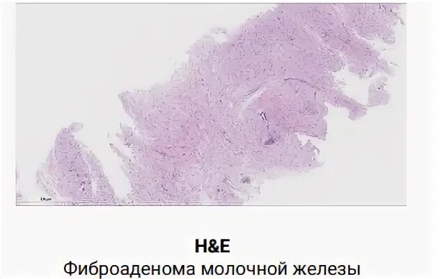 Чем лечить фиброаденому молочной железы отзывы. Чем лечить фиброаденому молочной железы отзывы. Локальный фиброаденоматоз молочной железы. Удаленная фиброаденома. Листовидная фиброаденома рентген.