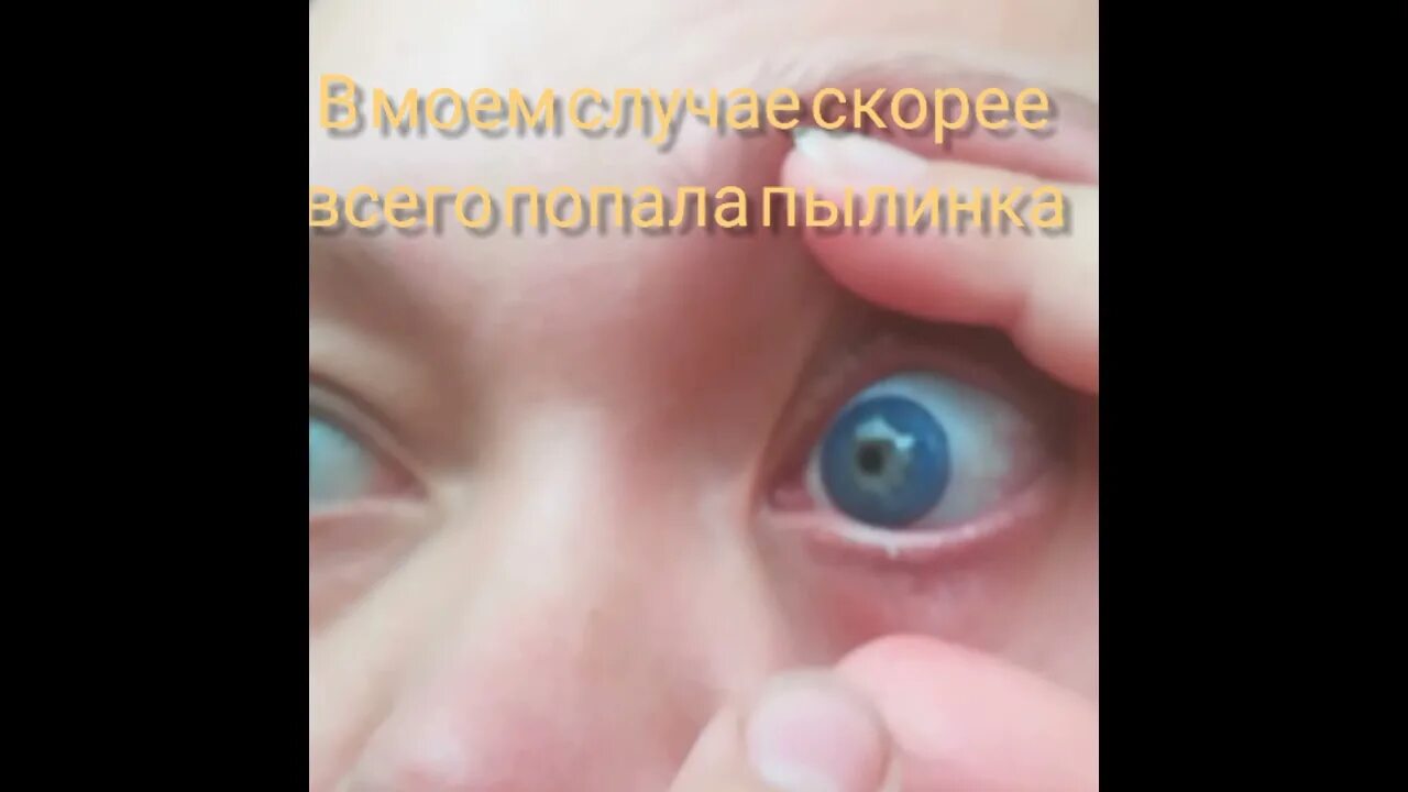 Как одевать линзы детям видео. Как снять линзы. линза застряла в глазу как снять.