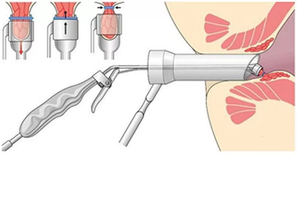 После лигирование геморроидальных узлов. Лигирование узлов латексными кольцами. Лигирование геморроидальных узлов (1 узел). Инфракрасная коагуляция геморроя.
