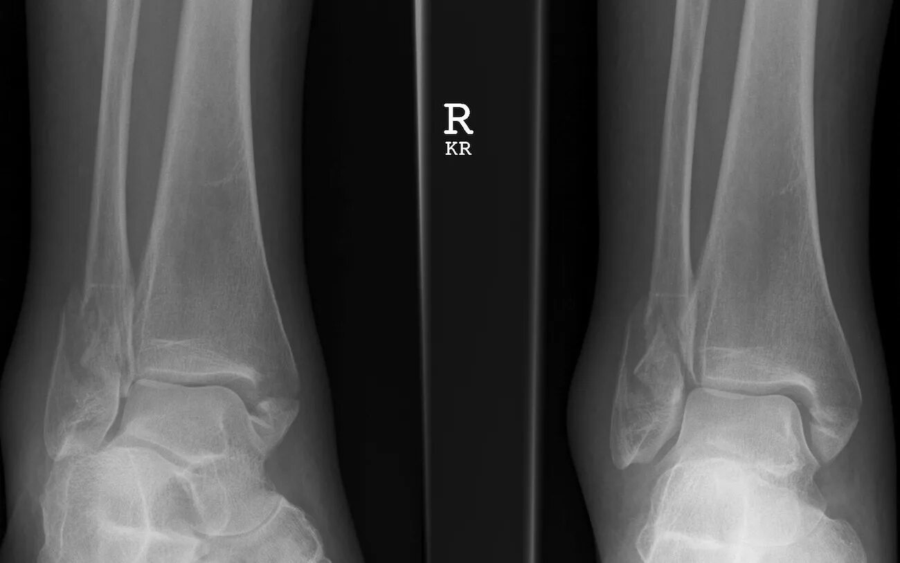 Трещина голени. Пронационный перелом лодыжки. Перелом Дюпюитрена лодыжки. Перелом Дюпюитрена рентген. Перелом наружной лодыжки малоберцовой кости.