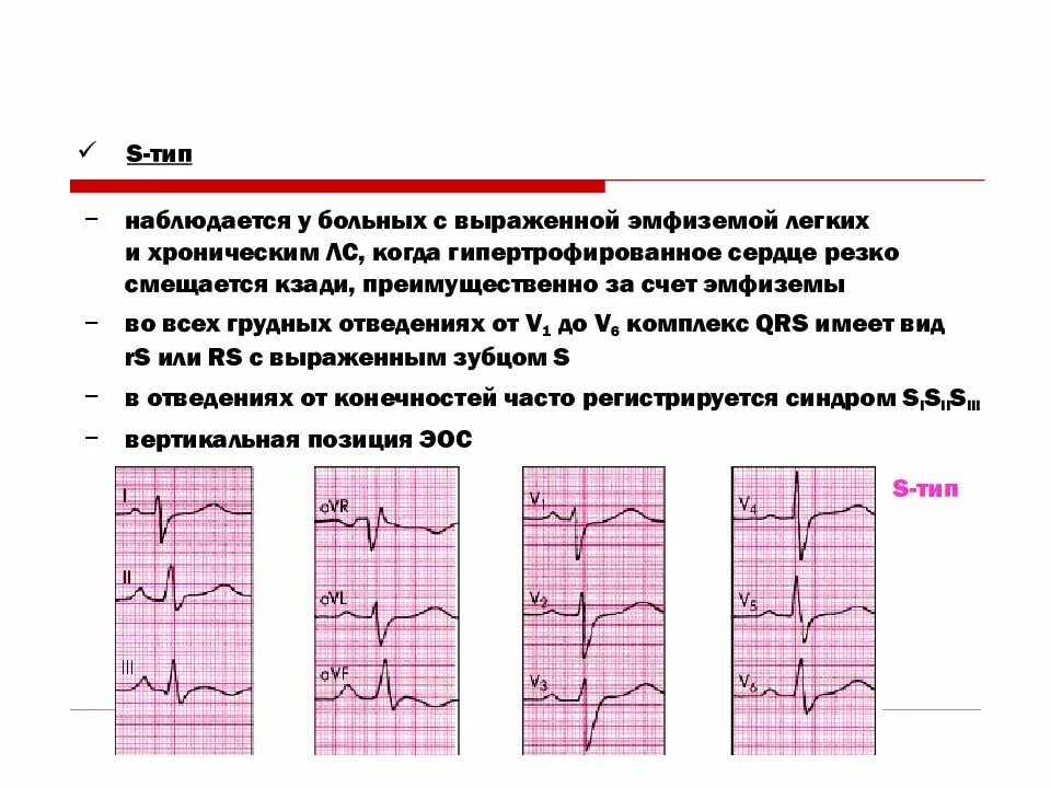 Эос типа. Хроническое легочное сердце экг. экг при хроническом легочном сердце. s тип эос на экг. легочная недостаточность на экг.