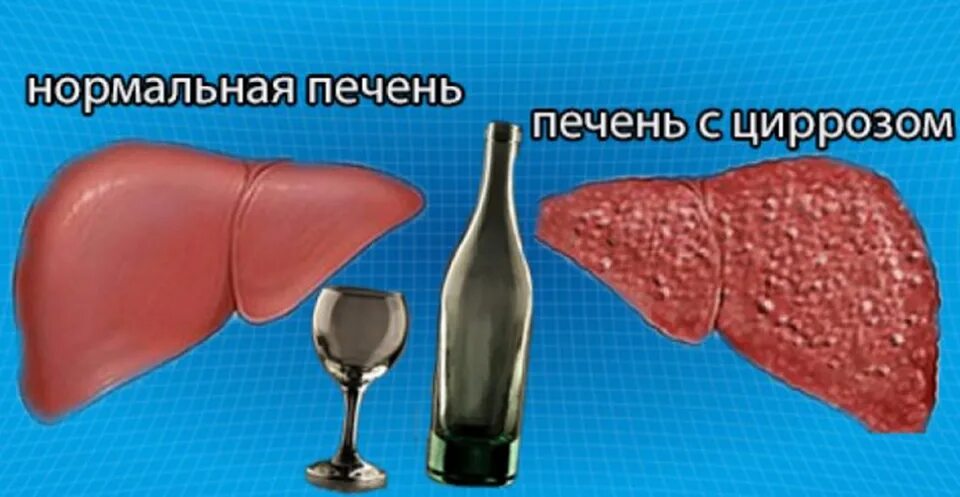 Цирроз печени клиническая картина. Цирроз печени дифференциальная диагностика. Алкогольное поражение печени стадии. Алкогольный цирроз печени. Алкогольный цирроз симптомы.