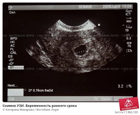 Какое узи делают на раннем сроке беременности. УЗИ беременности на ранних сроках. УЗИ беременных на ранних сроках. Снимок УЗИ на раннем сроке. Снимок УЗИ беременности на ранних сроках.