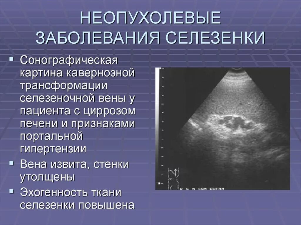 Увеличена печень диагноз. УЗИ картина хронического панкреатита. Хронический панкреатит УЗИ. Острый панкреатит при УЗИ. Хронический панкреатит диагностика УЗИ.