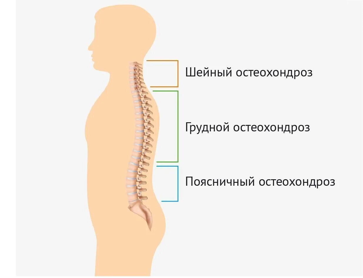 Остеохондроз шейный грудной поясничный. Остеохондроз грудного отдела грудной отдел. Остеохондроз th5-th8. Остеохондроз шейного отдела и поясничного отдела.