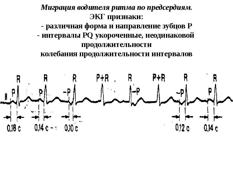 Миграция в сердце