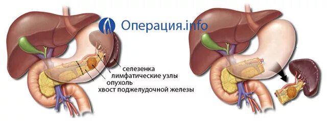 Опухоль поджелудочной железы что это. Липоматоз поджелудочной железы мрт. Классификация злокачественных опухолей поджелудочной железы. Метастазы в лимфоузлах поджелудочной железы. Метастазирование опухоли поджелудочной железы.
