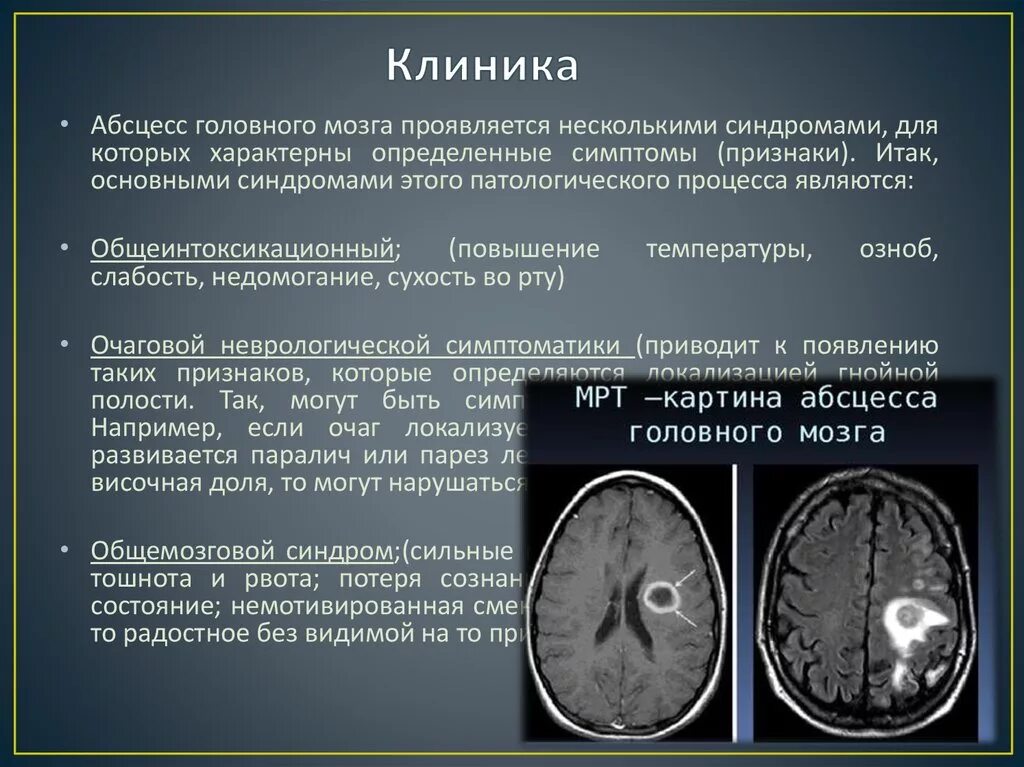 Абсцесс мозга. Абсцесс головного мозга симптомы. Абсцесс головного мозга клиника. Стадии формирования абсцесса головного мозга.