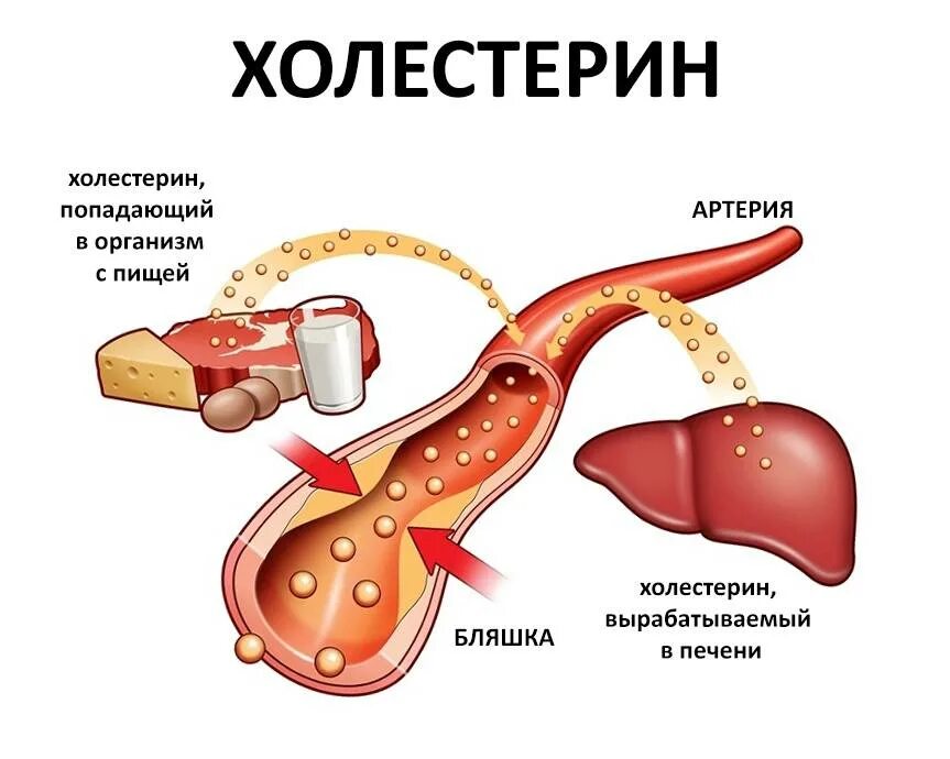 Сильно повышенный холестерин. Высокий холестерин влияние на организм. Повышение уровня холестерина в крови. Повышенный уровень холестерина. Холестт.