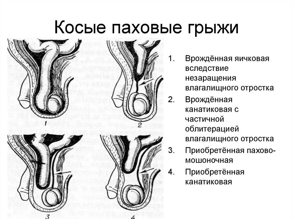 Как отличить грыжу