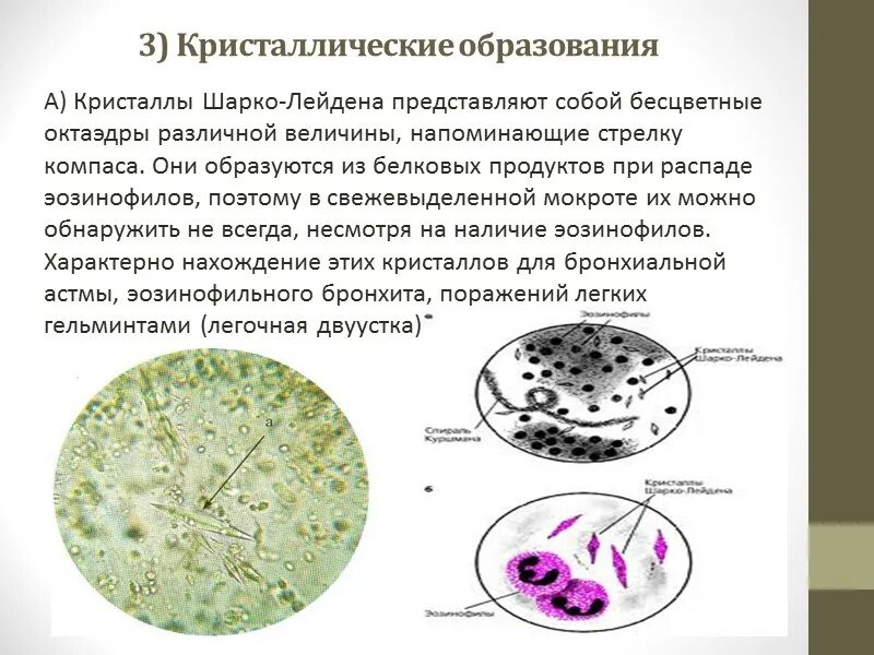 Спирали Куршмана и Кристаллы Шарко-Лейдена. Кристаллы Шарко Лейдена. Кристаллы Шарко-Лейдена в мокроте. Спирали Куршмана, Кристаллы Шарко-Лейдена, эозинофилы. Куршмана кристаллы шарко лейдена