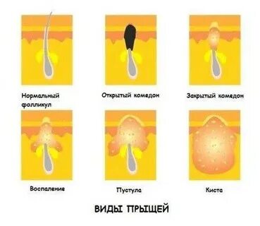 Стадии прыща