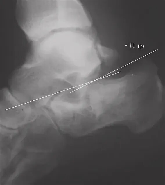 Операция пяточной кости. Языкообразный перелом пяточной кости. Перелом пяточной кости рентген. Клювовидный перелом пяточной кости. Таранная кость рентген.