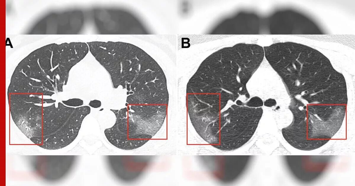 Поражение легких при ковиде. Кт легких снимок коронавирус. Амиодароновое легкое кт. Синусы легких на кт.