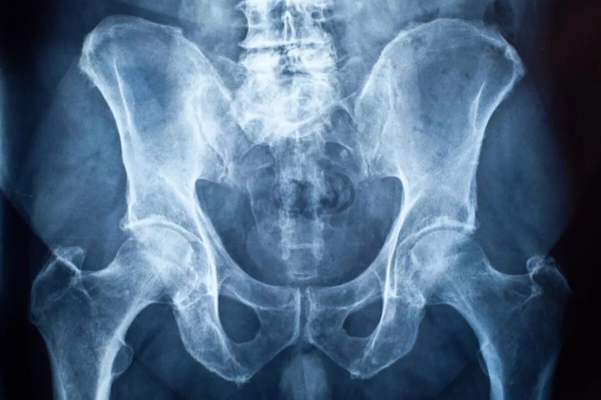 Снимок. Рентген костей малого таза. Рентген костей таза норма.