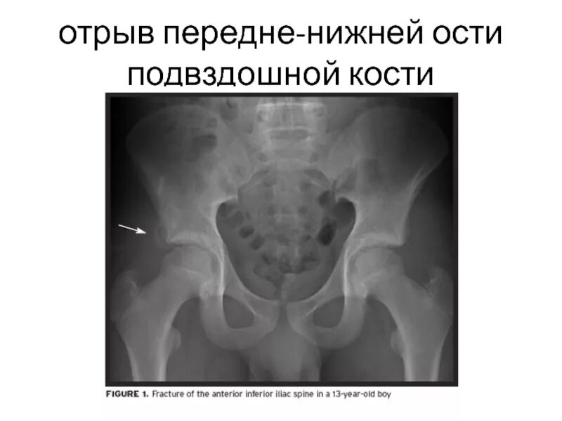 Краевой перелом подвздошной кости. Перелом нижней передней ости подвздошной кости. Перелом тазовой кости рентген. Краевые переломы костей таза.