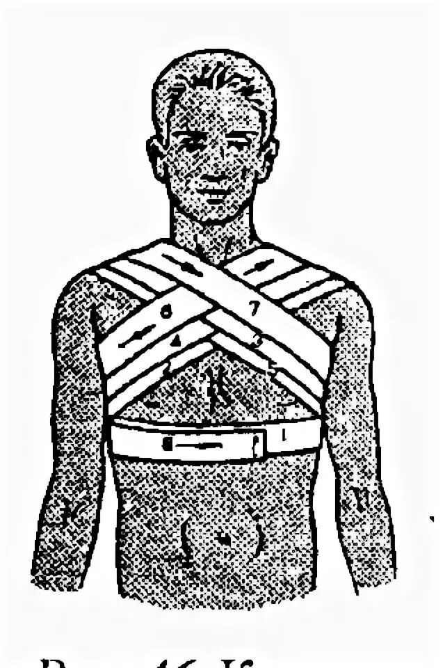 Повязка на грудную клетку алгоритм. Восьмиобразная повязка на грудную клетку. Крестообразная на грудную клетку. Восьмиобразная гипсовая повязка. Лейкопластырная повязка на грудную клетку.