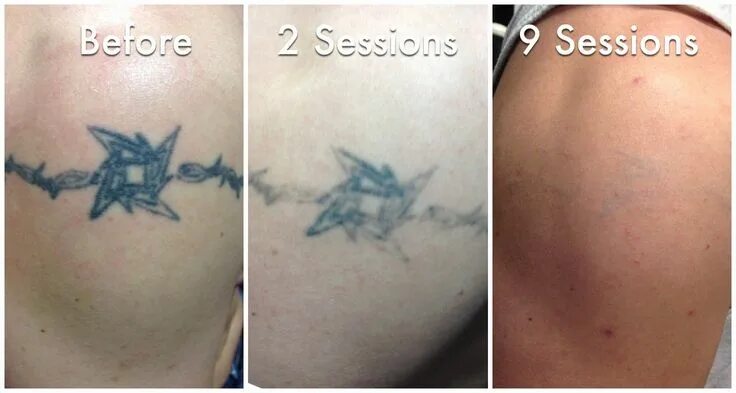 Laser Tattoo Removal Chattanooga Tn Unique Irreproachable E Time Tattoo Removal 