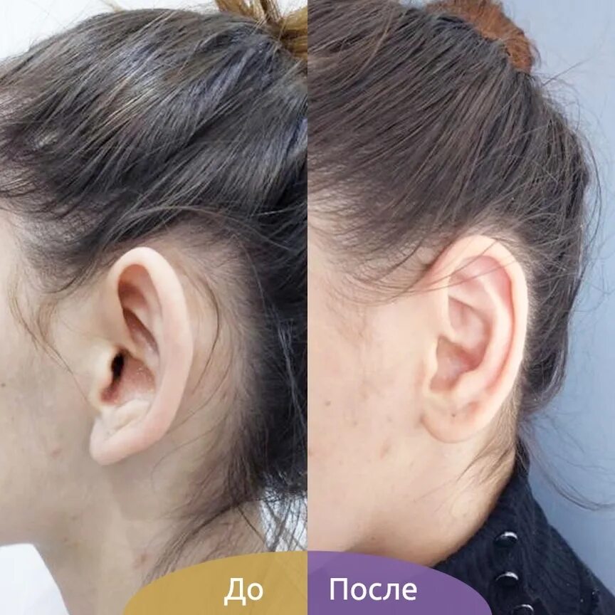 отопластика видео