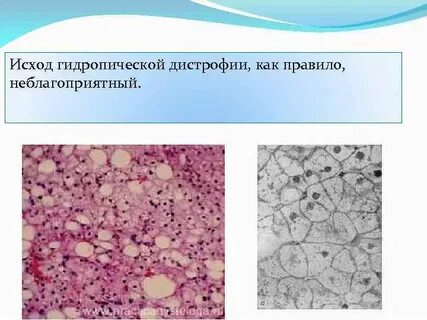 Белковая дистрофия печени