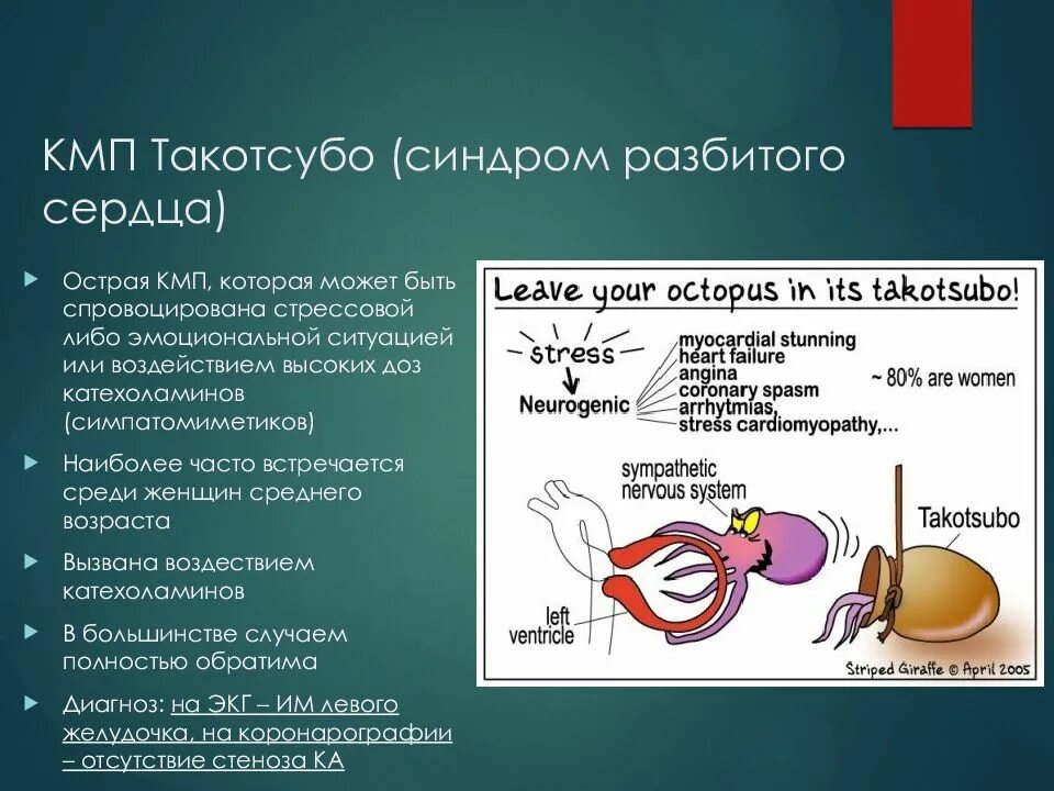 Синдром разбитого сердца симптомы. Кмп такотсубо. синдром разбитого сердца. токатсубо кмп диагностика.