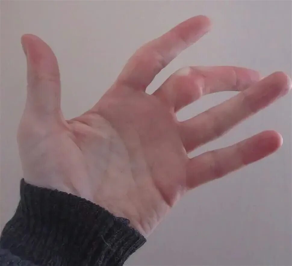 сломанный средний. перелом безымянного пальца. сломанный средний. перелом 1 фаланги мизинца. ушиб среднего пальца на руке.