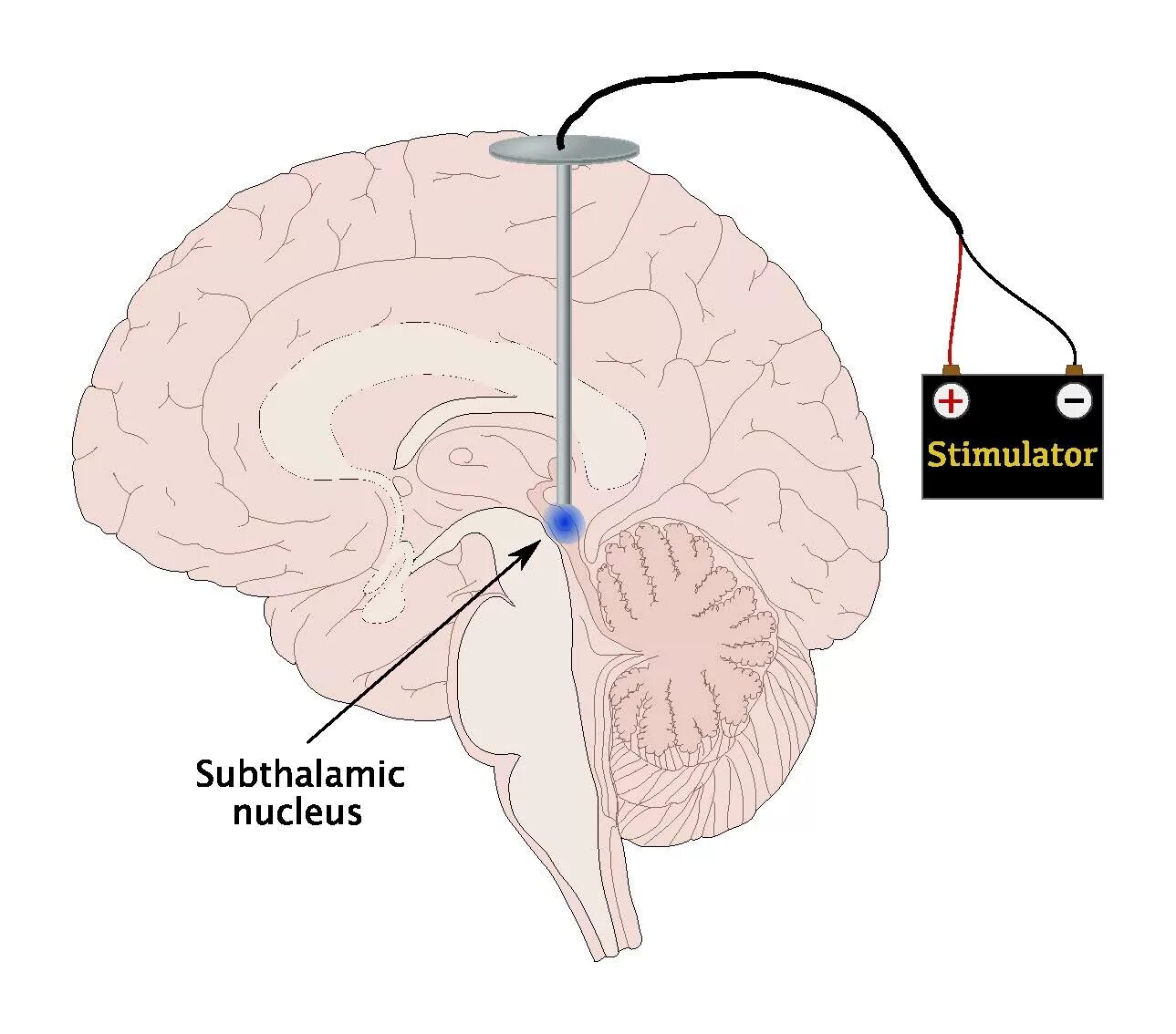 Deep brain. Глубокая стимуляция головного мозга. Стимуляция глубоких структур мозга. Глубокая стимуляция мозга при болезни Паркинсона.