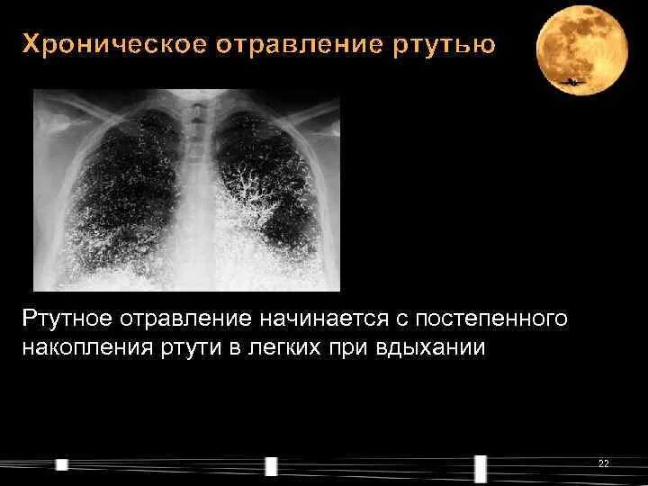 Отравление ртутью. Ртуть на рентгеновском снимке. Отравление ртутью рентген. Хроническое отравление ртутью. Ртуть влияние на человека