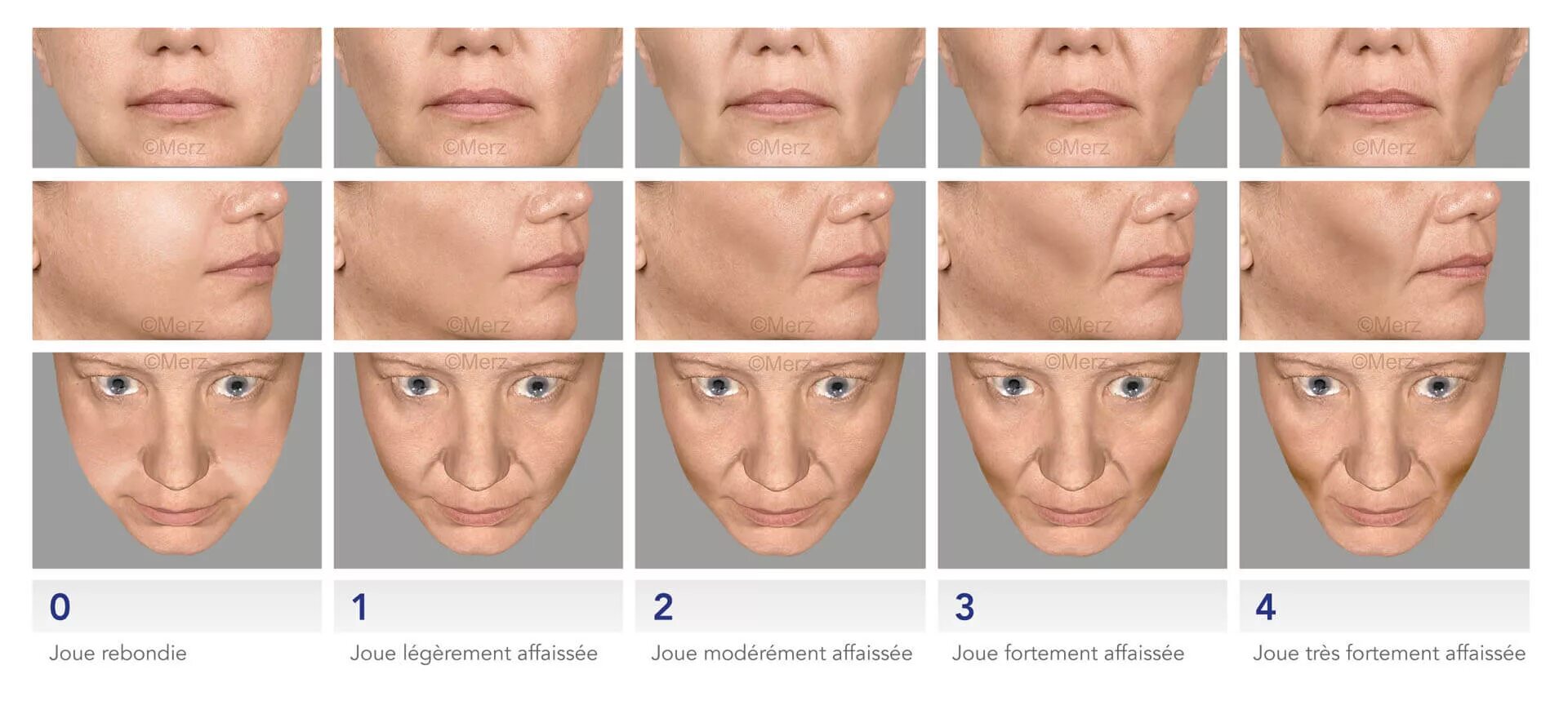 Возрастные изменения у мужчин. Типы морщин. Возрастные изменения лица. Типы морщин на лице. Типы старения лица у женщин.