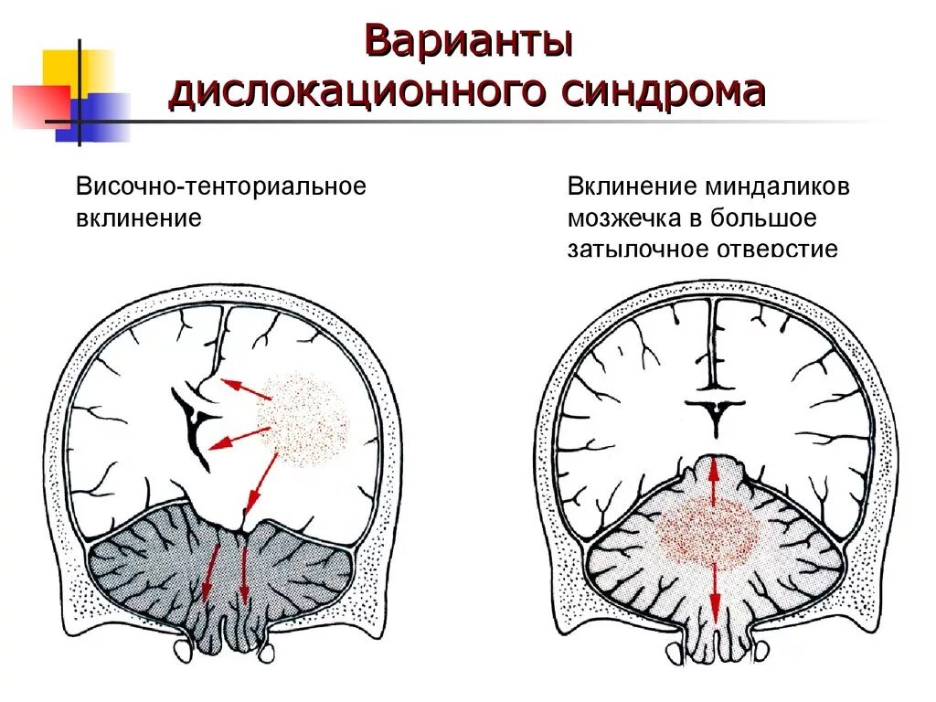 Признак жизни головного мозга. Дислокационные мозговые синдромы. Синдром дислокации мозговых структур. Дислокационный синдром неврология клиника. Дислокационный синдром этиология.