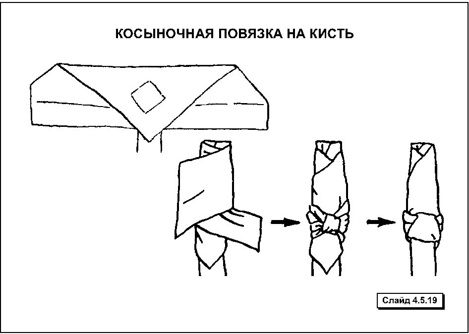 Комвночная повязка накисть. Восьмиобразная косыночная повязка. Косыночная повязка на кисть. Косыночные повязки на стопу. Косыночная повязка на кисть.