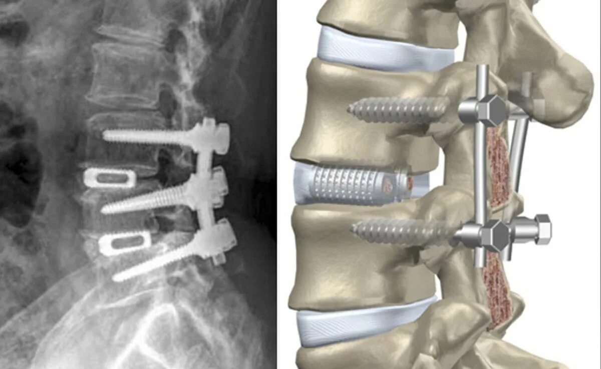 Транспедикулярный остеосинтез. Транспедикулярная фиксация позвоночника l5-s1. Транспедикулярная фиксация l5-s1 позвонков. Операция антелистез l5. Операция по замене позвоночника