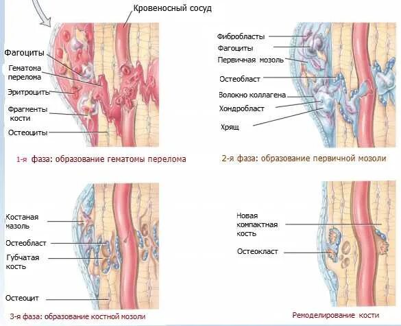 Механизм сращивания костей. Стадии регенерации перелома кости. Этапы сращения перелома кости.