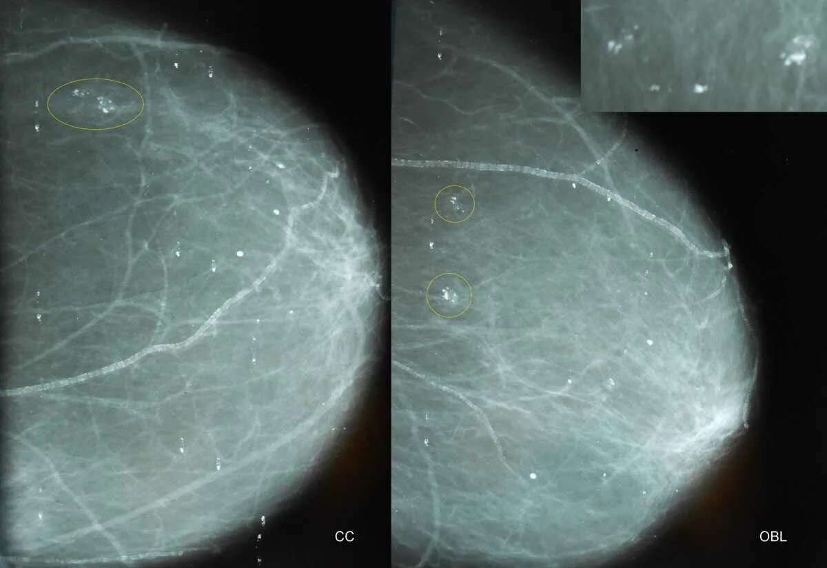 Округлые кальцинаты. Кальцинаты на маммографии. Внутрипротоковые кальцинаты. Маммография кальцинаты доброкачественные.