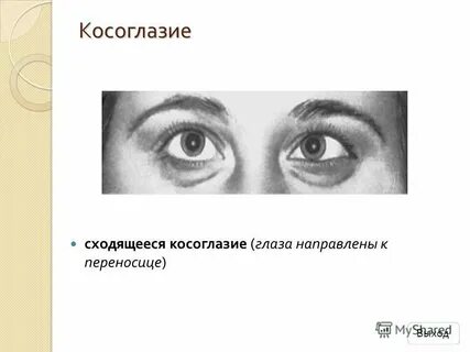 Сходящееся косоглазие код по мкб у детей