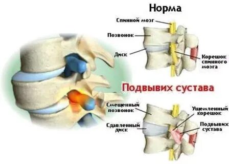 Симптомы подвывиха позвонка